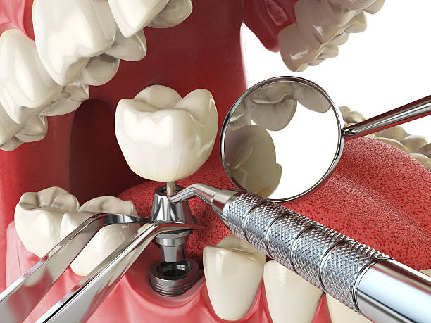Best Root Canal Emergency Dentist  in Piru, CA